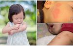 Myggenbid på huden hos en voksen eller et barn