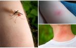 Koja je razlika između ujeda komarca i kukca