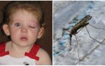 Hvad skal man gøre, hvis et barn har et bløt øje efter en mygbete