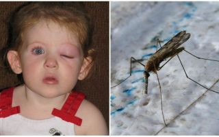 Co zrobić, jeśli dziecko ma opuchnięte oko po ukąszeniu komara