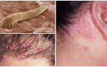 Symptomer og behandling af hårmide hos mennesker