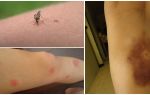 Zašto modrice ostaju nakon uboda komaraca?