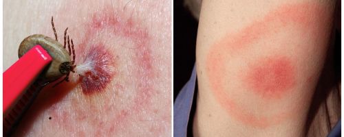 Wat is de ziekte van Lyme, de symptomen, de behandeling en de foto