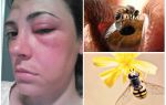 Hva om biet biter i øyet og det svulmet