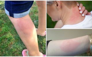 Tratamiento de las alergias a las picaduras de mosquitos en adultos y niños.