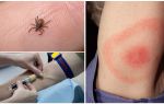 Xét nghiệm máu cho borreliosis