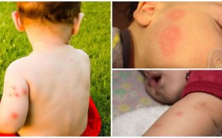 Ταμεία για παιδιά μετά από τσιμπήματα κουνουπιών