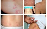 Hvad ser bedbugs bites på menneskets hud?