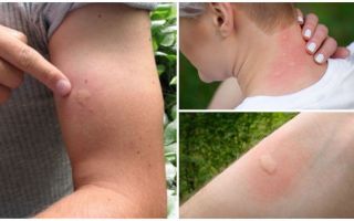 Πώς να αφαιρέσετε πρήξιμο και φαγούρα από τσιμπήματα κουνουπιών σε ένα παιδί και έναν ενήλικα