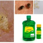 Cyclox θεραπεία για bedbugs