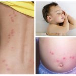 Bedbugs bite kvinner og barn