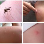 Τσιμπήματα κουνουπιών