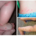 Bedbug biter hos barn-1