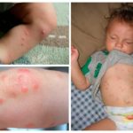 Bedbug biter hos barn