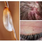 Nguy hiểm của pediculosis