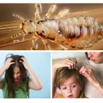 Pediculosis in children