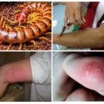 Centipede bite