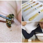 Tretiranje pčelinjeg otrova