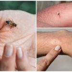 Bee, vết cắn của nó và sting