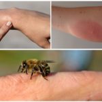 Bee sting og allergi mot det
