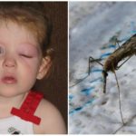 Hævede øjne på et barn fra en mygbete