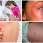 Osip kože sličan izbočinama nakon ujeda komarca