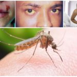 Moguće posljedice ujeda komaraca