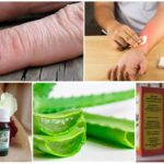 Remeis populars per a picades de mosquits i negres