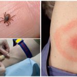 Blodtest for borreliosis efter en tippebid