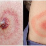 Doença de Lyme ou Borreliose transmitida por carrapatos
