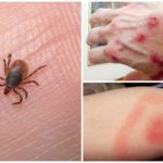 Tick ​​Bite Disease