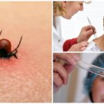 Tick ​​removal