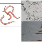 Pinworms u ljudima
