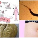 Pinworm infection